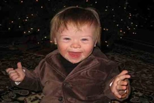 Mozaik Down Sendromu Belirtileri ve Tedavisi