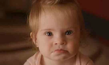 Down Sendromu Genetik Midir?